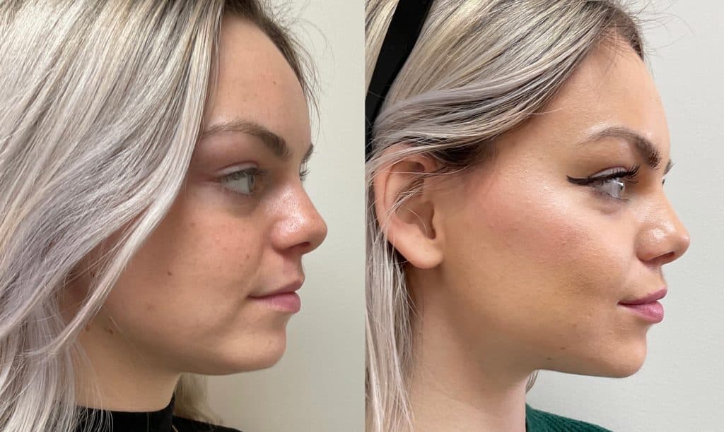 8 Point Face Lift