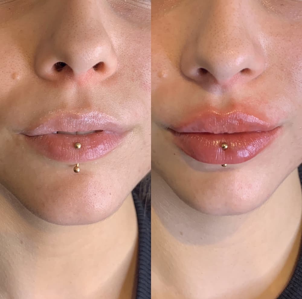 Lip Enhancement