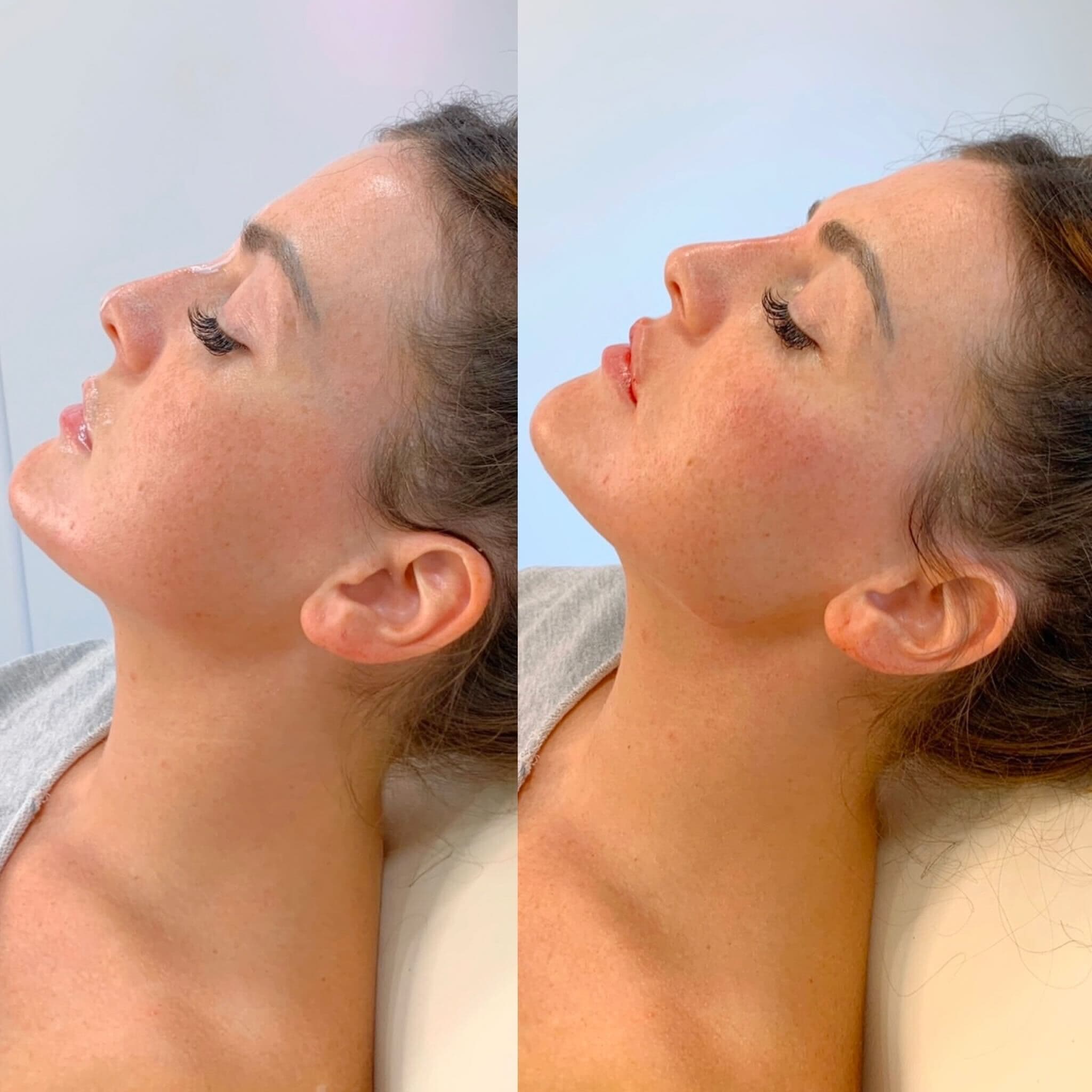 Define and sculpt your jawline with precision using dermal fillers.