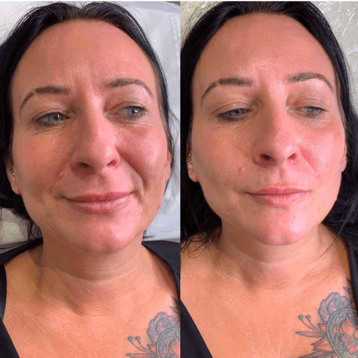 Smooth and rejuvenate your appearance with our targeted dermal filler treatment for nasolabial folds!