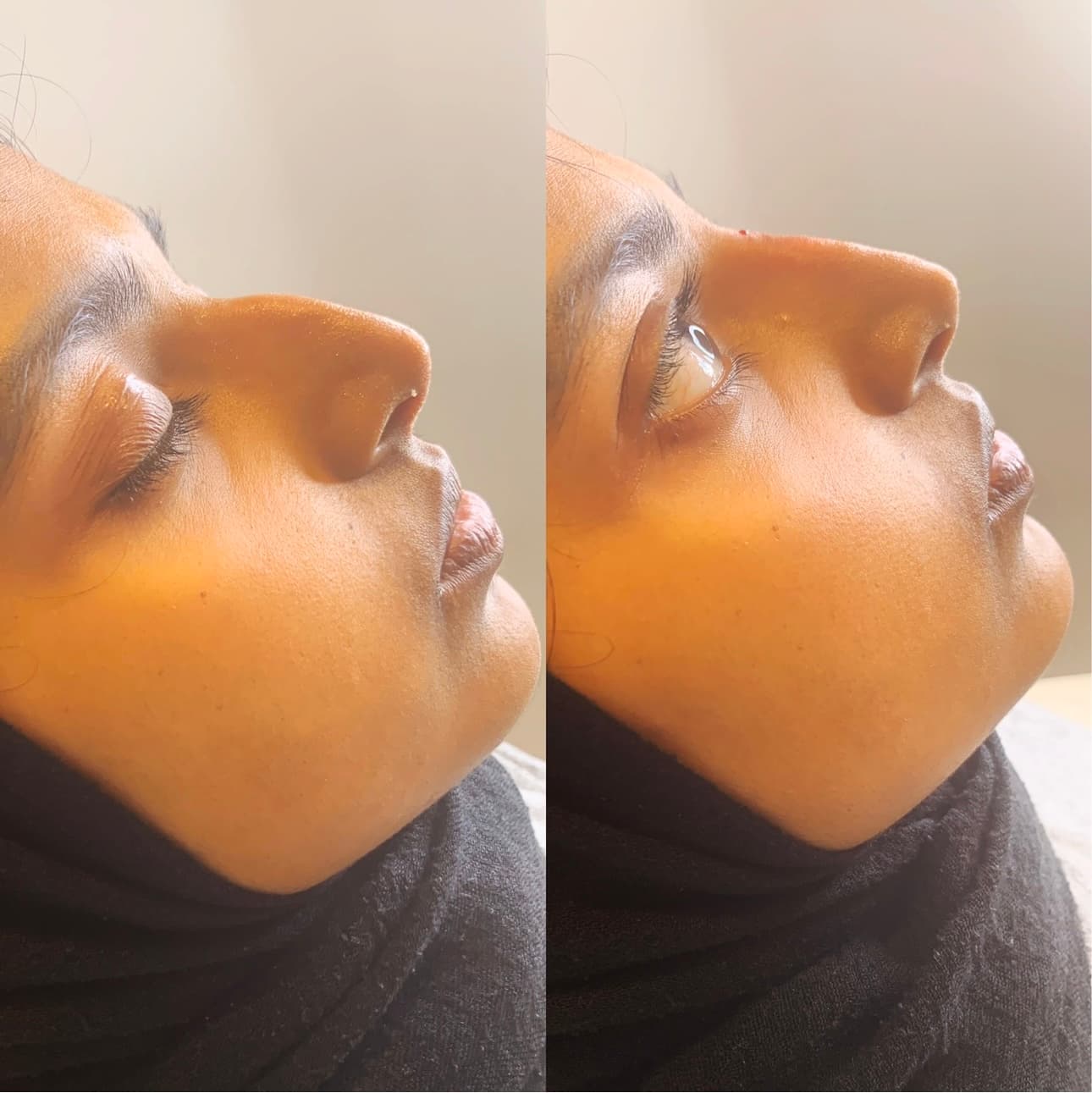 Transform your profile with non-surgical rhinoplasty using dermal fillers, an effective, non-invasive treatment to refine the shape of your nose.