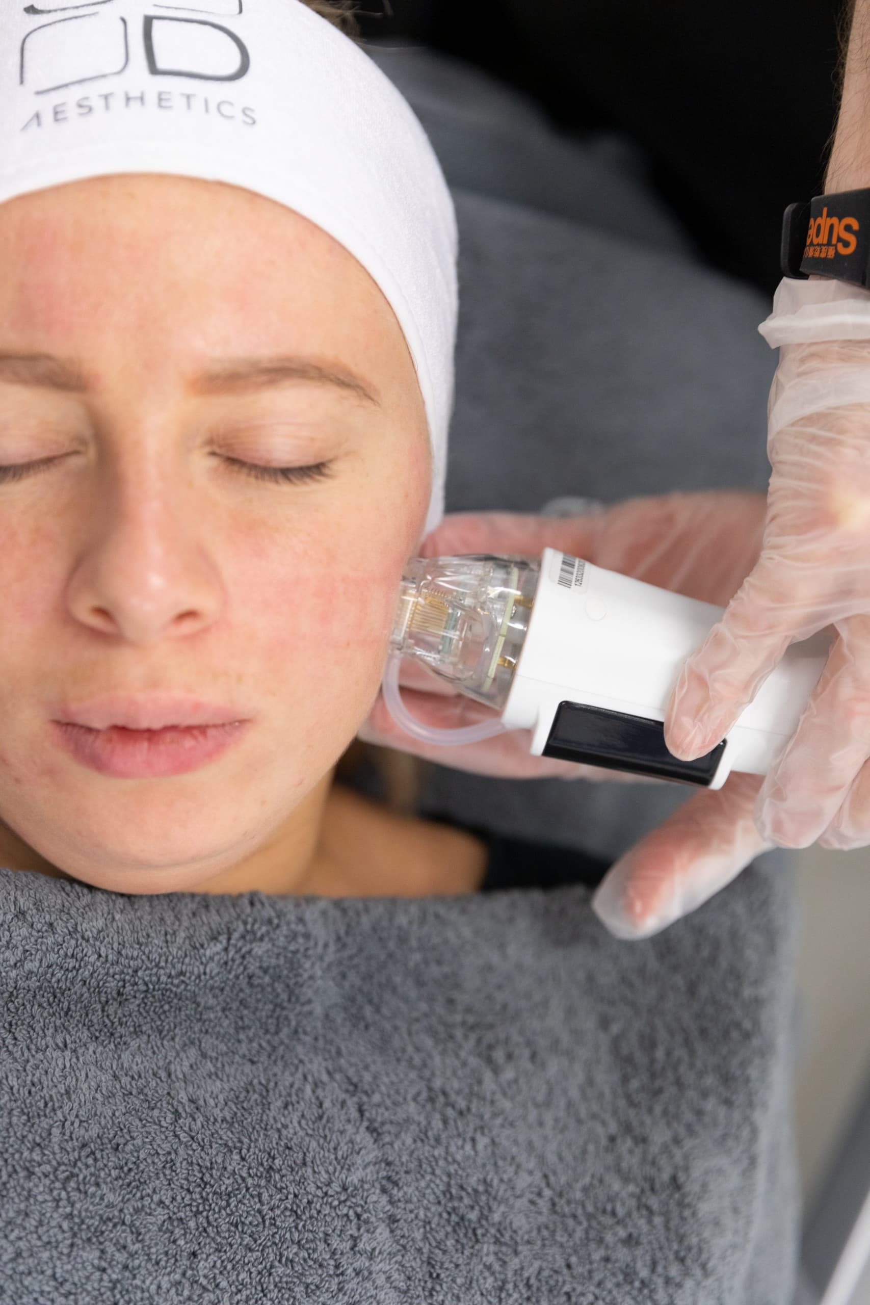 Dermaforce Rf Microneedling