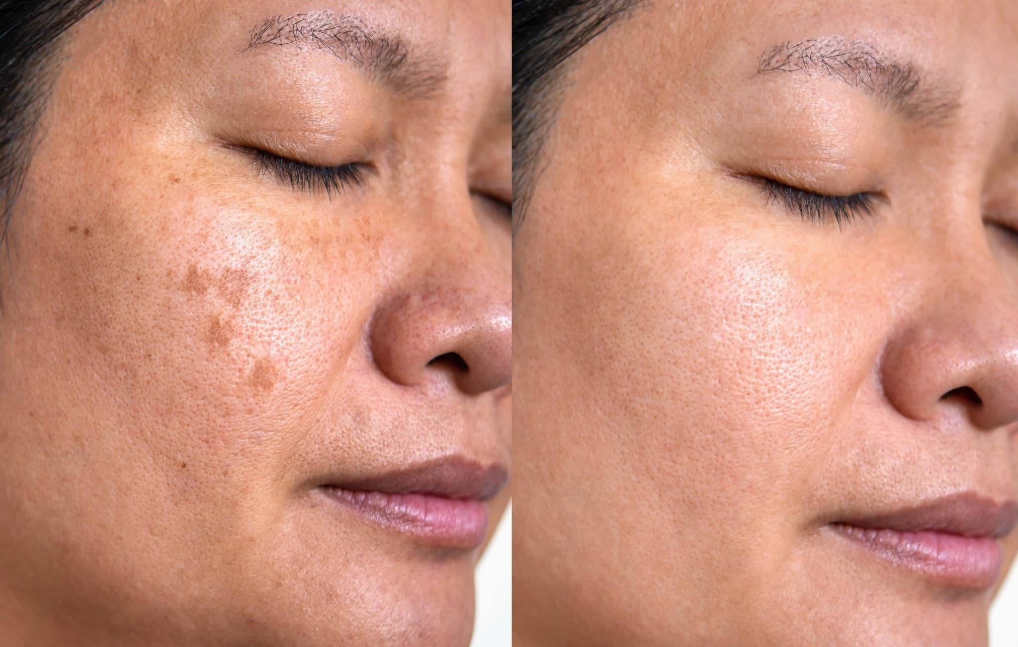 Pico Laser Hyperpigmentation Removal